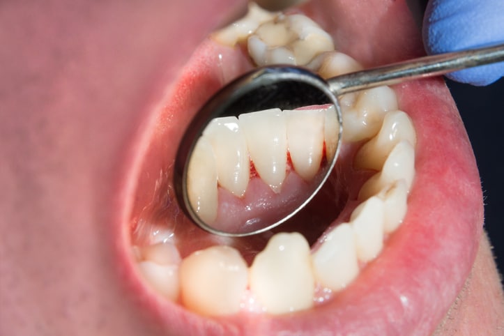 Are Bleeding Gums Are Sign To Visit A Downtown Dental Clinic?