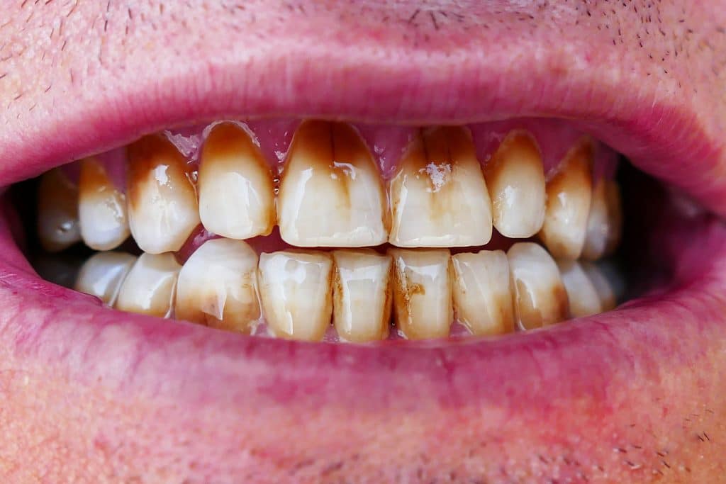 teeth discoloration