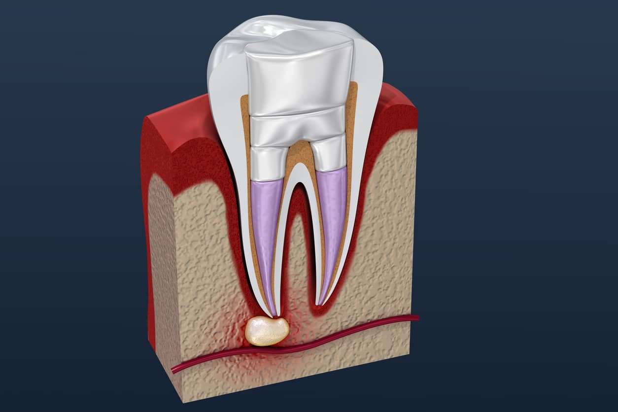 Common Root Canal Complications