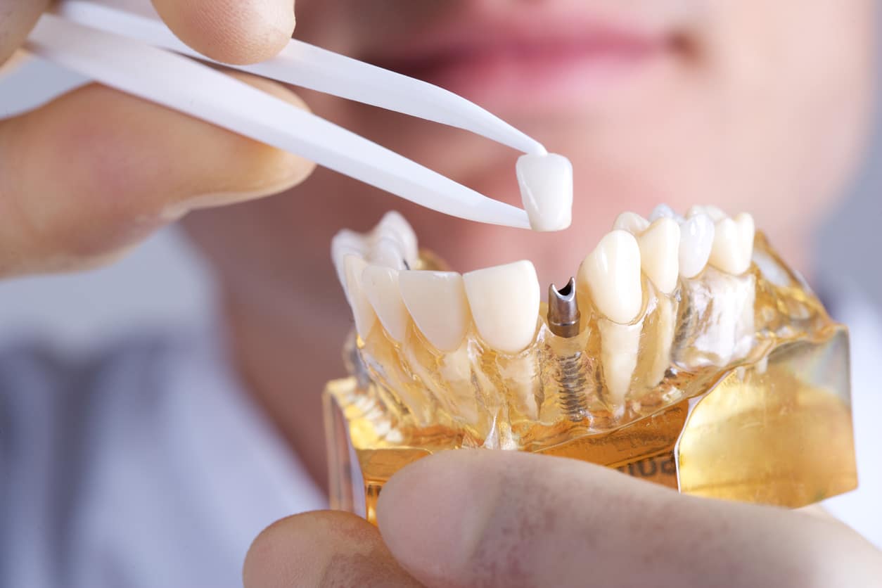 How Long Do Teeth Implants Last?