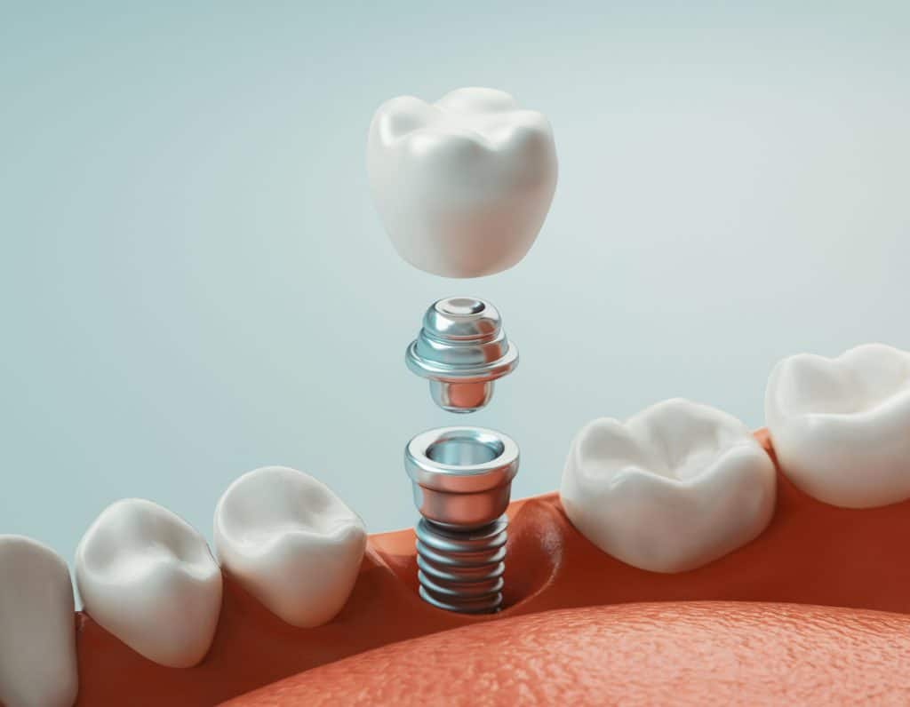 calgary-dental-implants