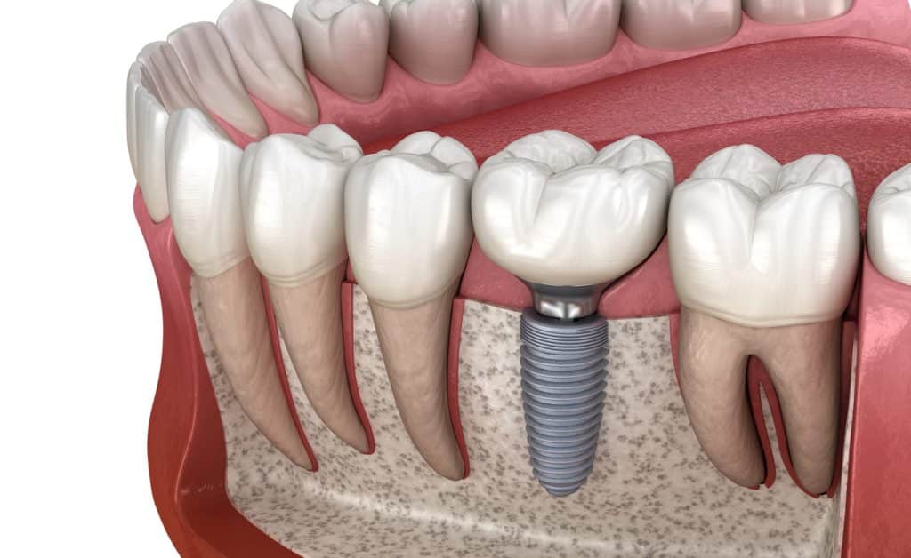 dental-implants-calgary