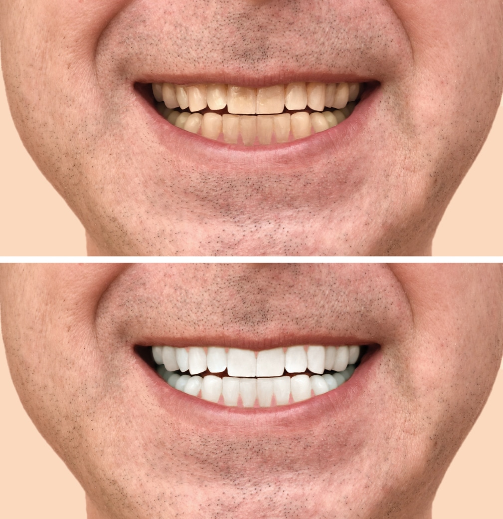Your Guide to Yellow Teeth